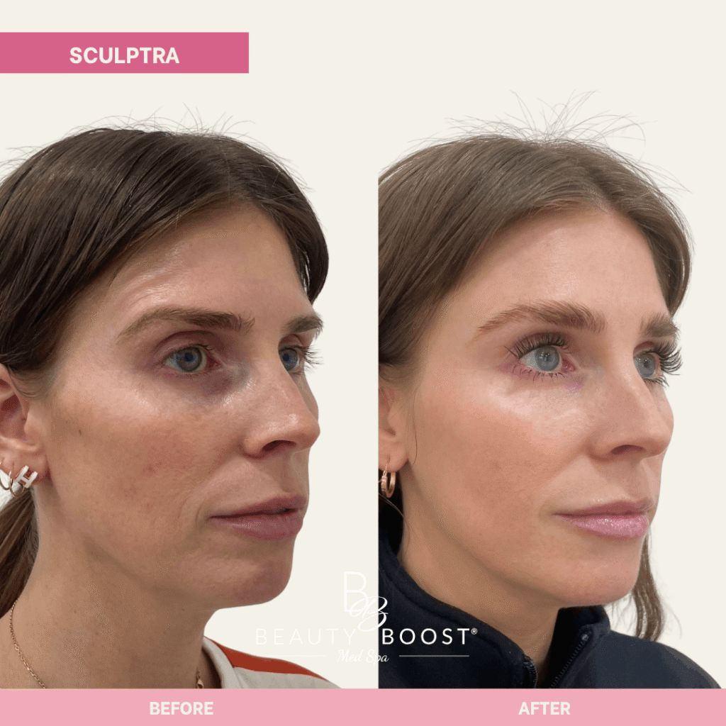 BBMS-sculptra-02 r oblique