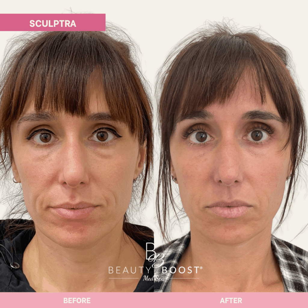 BBMS-sculptra-03
