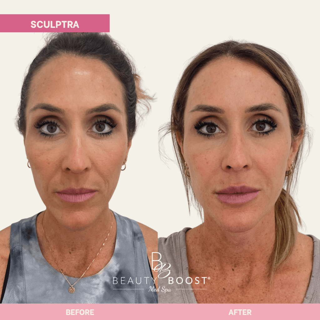 BBMS-sculptra-04 front