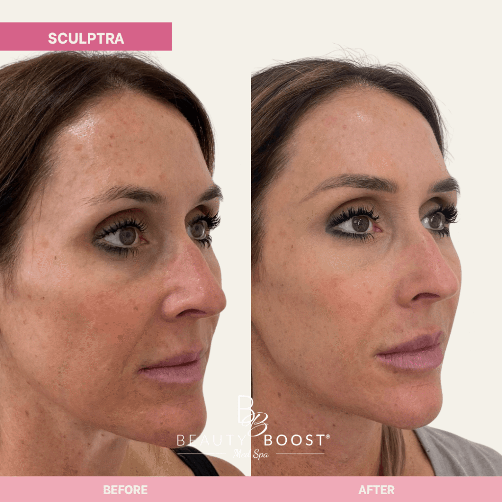 BBMS-sculptra-04 r obliuqe