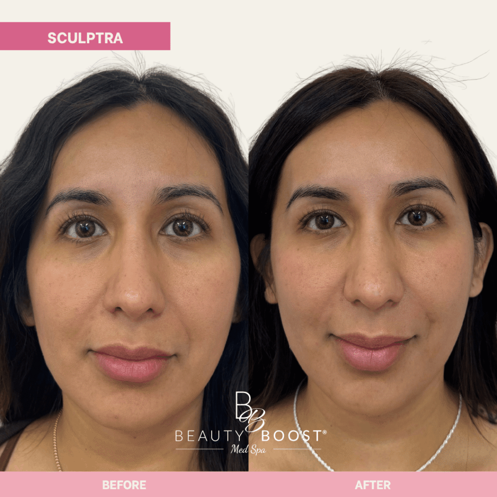 BBMS-sculptra-05 front
