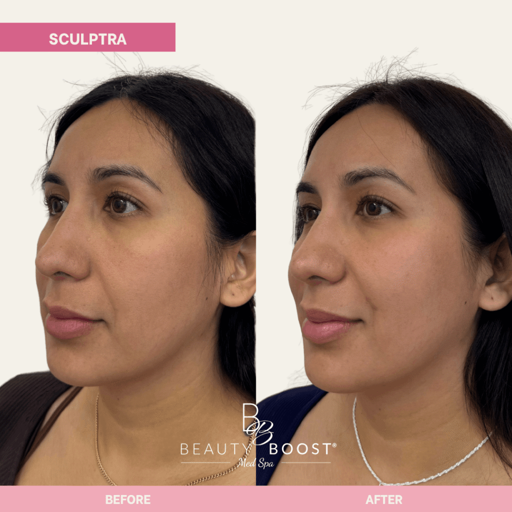 BBMS-sculptra-05 l oblique