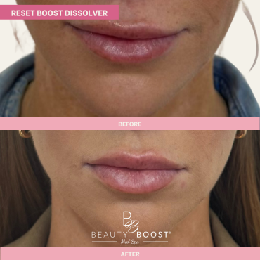 BBMS-DISSOLVER-02-FRONT